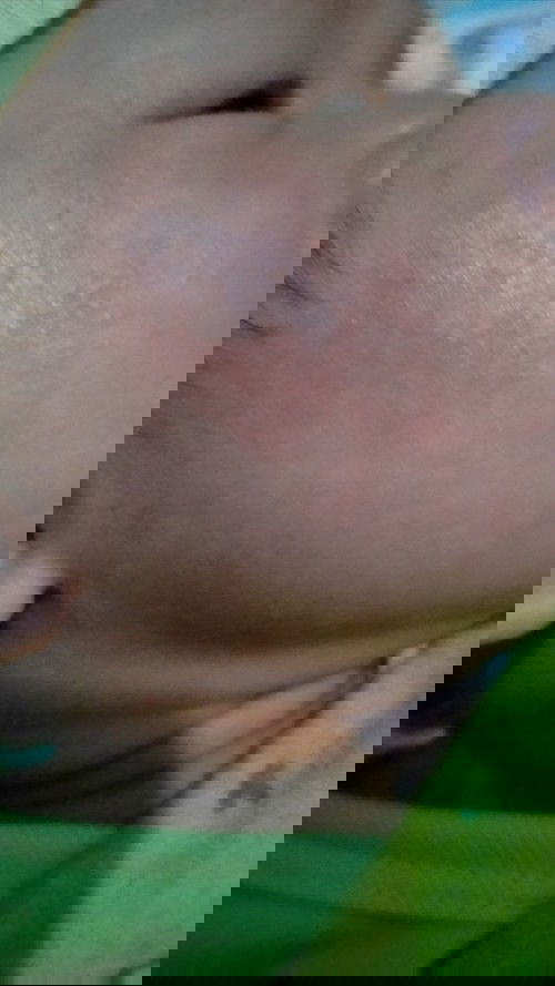 Muka bayiku bruntusan