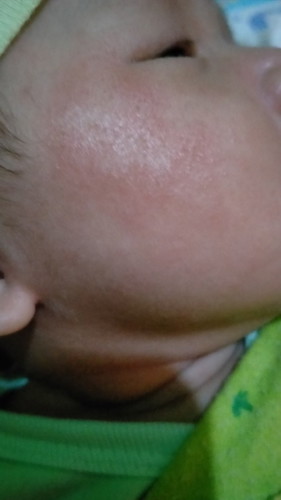 Muka bayiku bruntusan