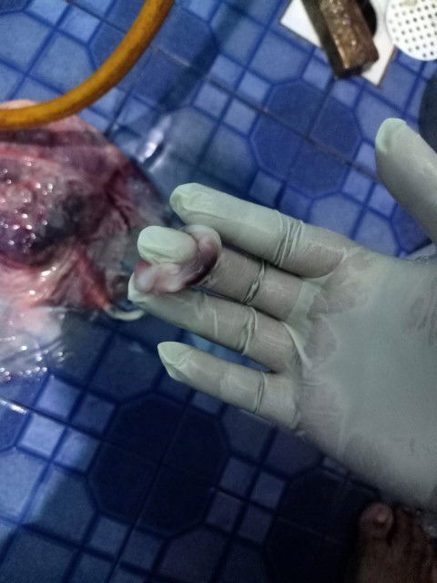 Apakah faktor plasenta pecah?