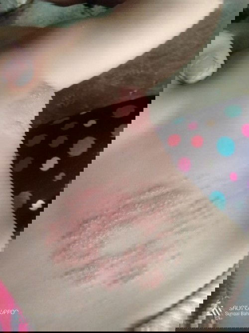 Elergi mpasi atau apa ya bun