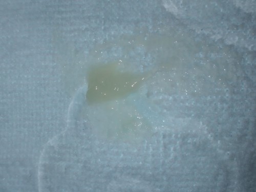 Vaginal discharge