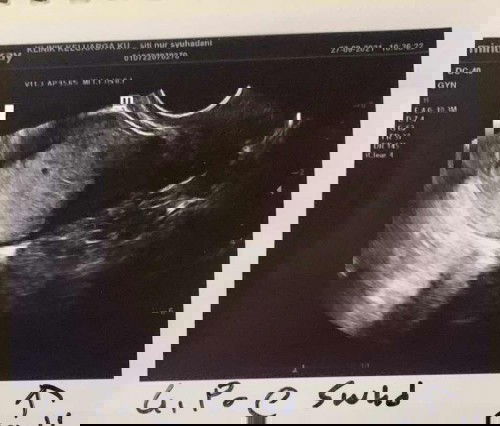 Scan kandungan 5 weeks