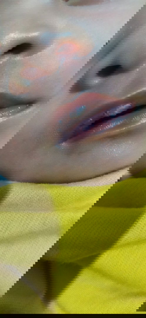 Putih putih keras pada ujung bibir Bayi usia 3 minggu