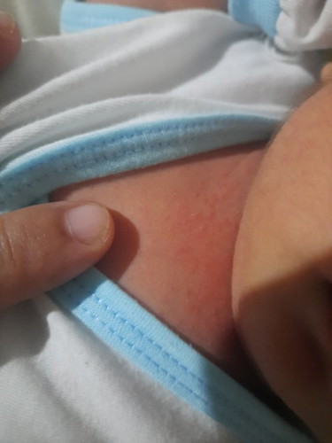 Red rash-like flaky skin ni baby. 3 weeks old po. Ano po ba dapat gawin kapag ganito skin ni baby?