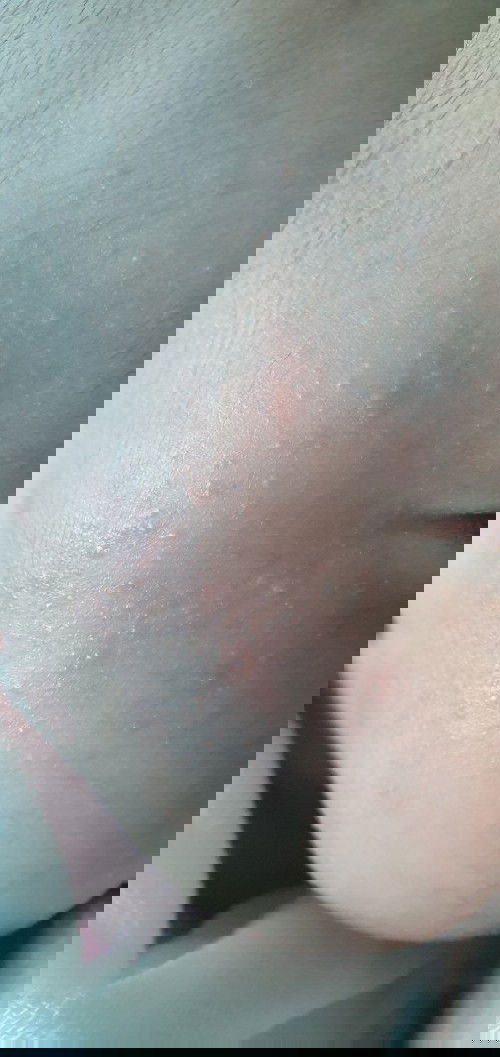 Các chị ơi cho e hỏi có cách rì giúp bé đỡ mụn này k ạ