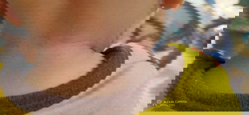 Anak saya bintik-bintik merah moms di sebalah leher kanan kiri dan belakang nya tapi depan nya gak??