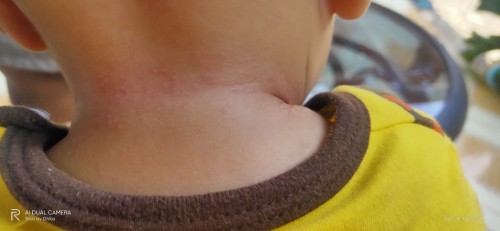 Anak saya bintik-bintik merah moms di sebalah leher kanan kiri dan belakang nya tapi depan nya gak??