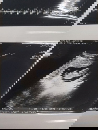 รูปอัลตราซาวน์