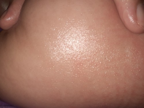 Kulit kering/ ruam ?