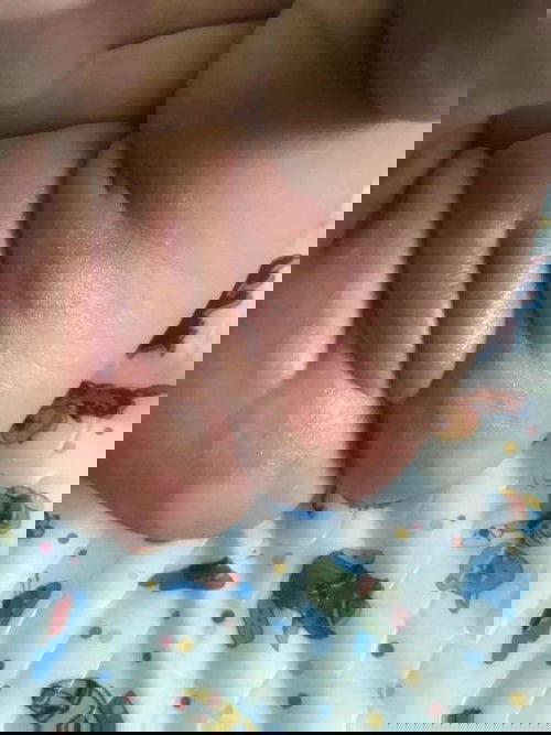 ผื่นผ้าอ้อม ก้นแดง แผลถลอก