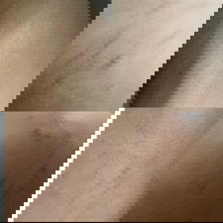 ช่วยด้วยค่ะ รอยแบบนี้จะหายไหมคะ