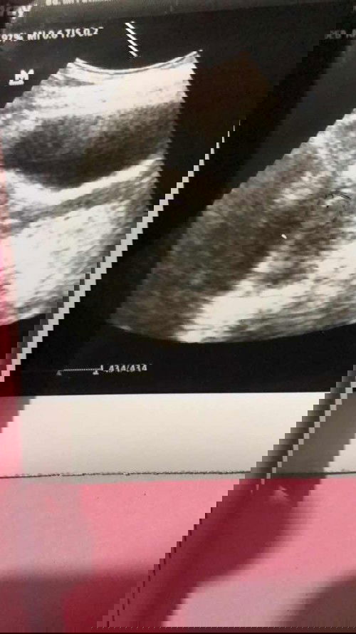 Terlihat kantung namun hasil lab negatif, tespack garis samar