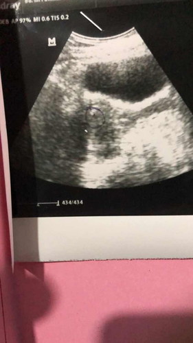 Terlihat kantung namun hasil lab negatif, tespack garis samar