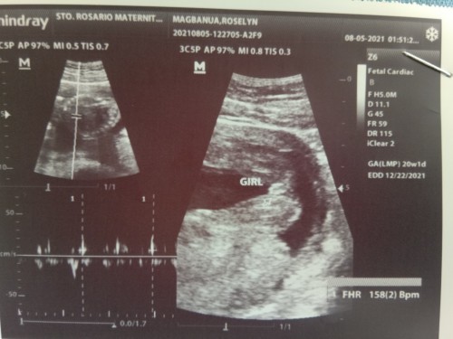 Hellow Po, ask ko lang Po kasi nag pa ultrasound Po ako Ng 20weeks , sure na po ba Yun? Nkita napo..