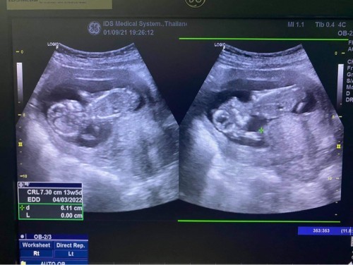 อยากทราบว่า “คุณแม่ได้ยาวิตามิน อะไรบ้าง จากคุณหมอ??”