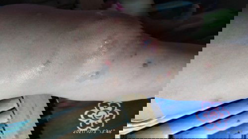 Pangangati sa Katawan ..