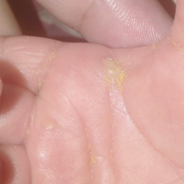 Tangan si kecil bentol berair