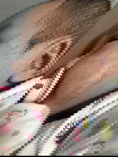 สอบถามผู้มีประสบการณ์ มีผื่นขึ้นที่หน้าลูก