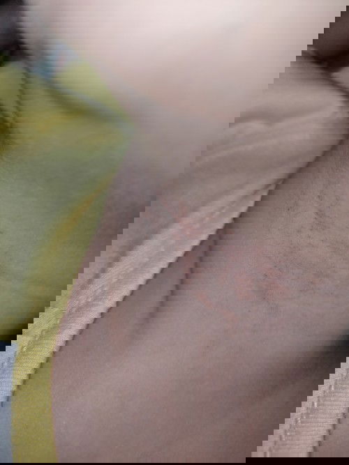 Mau tanya bintik dileher sperti ini pada anak 1 tahun