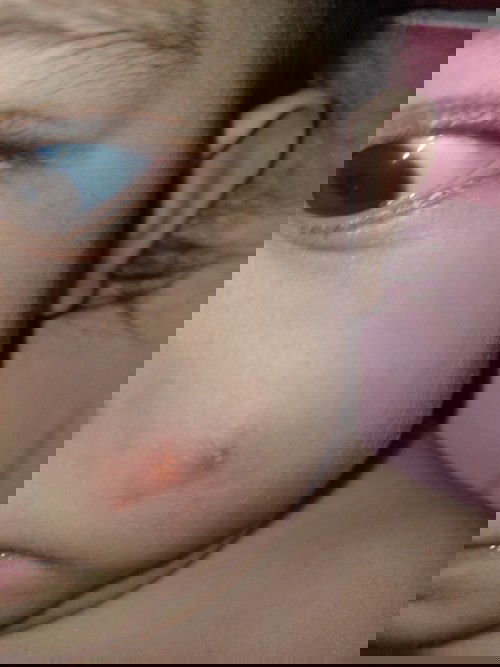 Apakah ini di gigit nyamuk atau serangga lain?