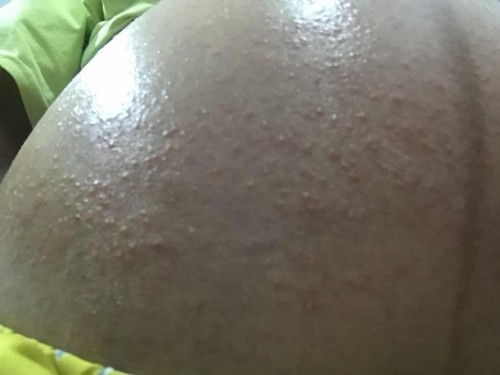 ผื่นขึ้น คันตามท้อง แขน และมือ แม่ๆท่านไหนเคยเป็นบ้างคะ