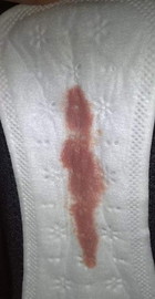 normal po ba dinudugo 37weeks napo ako ganito itsura nya di po ba nakakaaffect sa baby?😪😔😔😔😔😔