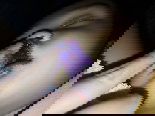 เส้นเอ็นฟันบนลูกฉีก