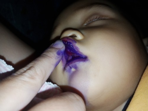 เส้นเอ็นฟันบนลูกฉีก