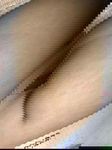 ตุ่มขึ้นตามแขนตามขา