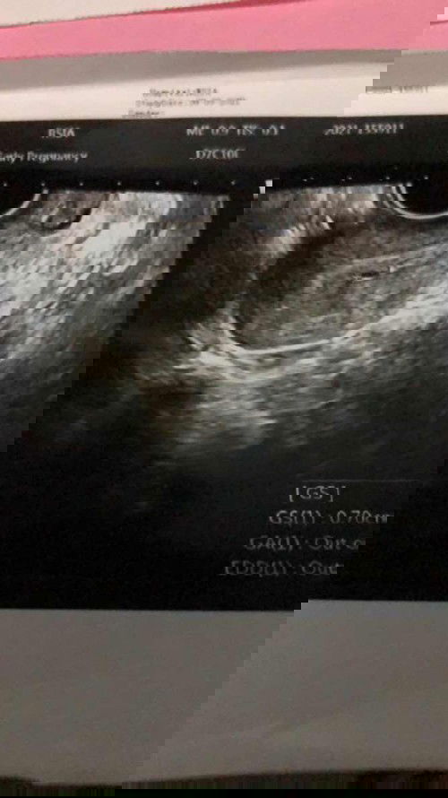 Ada kantung janin tapi hasil tespack negatif