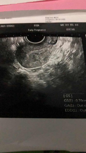 Ada kantung janin tapi hasil tespack negatif