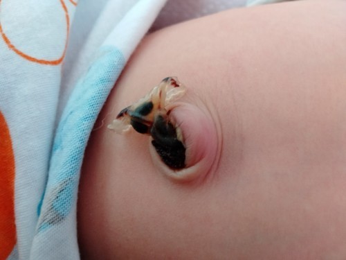 Các mẹ ơi rốn ntn có sao không ạ mới có con lần đầu nên e thiếu kinh nghiệm các mẹ tư vấn cho em với