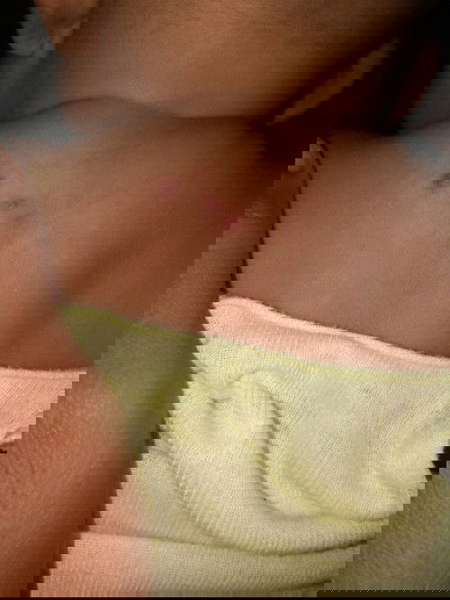 Mama dan bunda kenapa ya punggung si kecil saya bintik seperti ini. Tapi dia ngak demam.