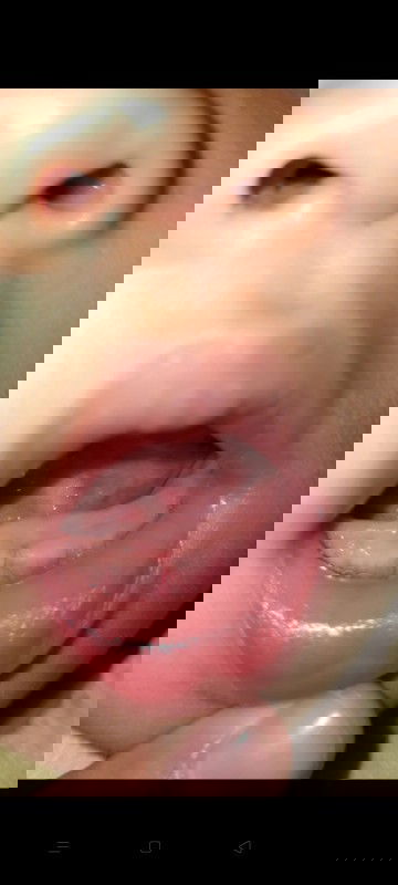 Gusi bayi 10 bulan bengkak ,apakah sariawan?