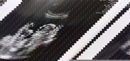 Berbagi pengalaman untuk para ibu yang mengalami hal yg sama