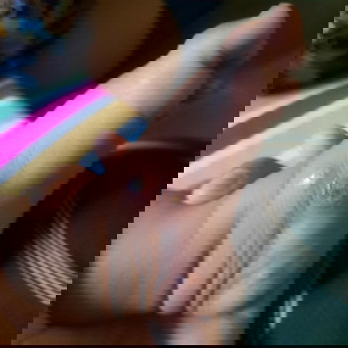 Bayi Tumbuh Bisul Berisi Nanah