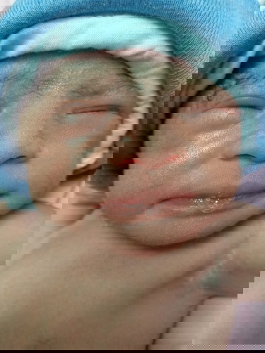 คลอดก่อนกำหนด