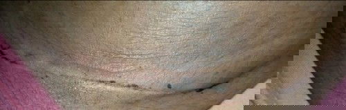 Bekas jaitan sc apakah bisa hilang