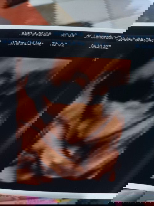 Sharing dong bunda2, saya baru USG ke dua uk 31week kata dokter baby nya kecil