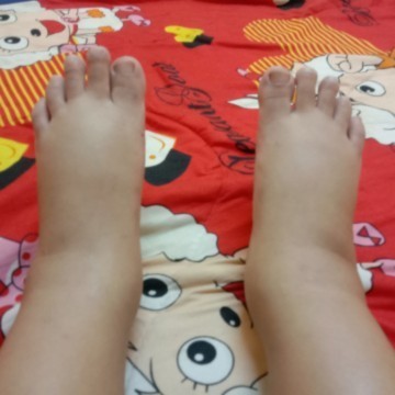 เป็นอันตรายไหมค่ะแม่ๆท้องแรกค่ะ34w2d จริงๆเคยบวมแต่ไม่ขนาดนี้เมื่อเดือนที่แล้ว