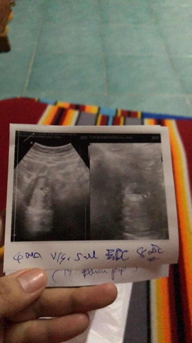 เสี่ยงหลุดเนื่องจาก รกเกาะต่ำ