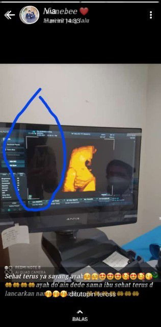 HPL 20 oktober, bisa maju tgl 15 udah sering linu" dikaki sama kram haid apa itu tanda lahiran bun?