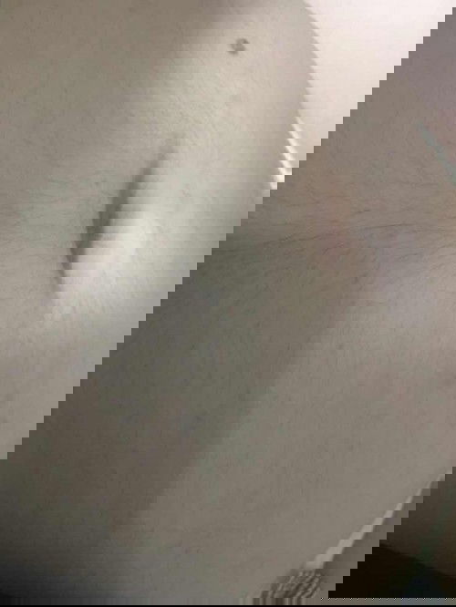 Lên mụn nhỏ li ti ở bụng bầu