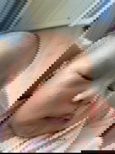 ผื่นทารก แบบนี้เป็นอะไร/กม