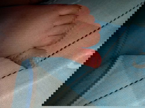 ลูกเป็นเล็บขบดูแลยังไงดี