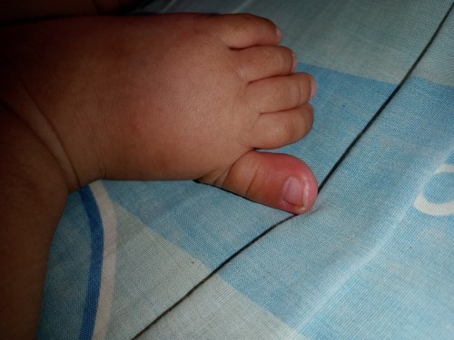 ลูกเป็นเล็บขบดูแลยังไงดี