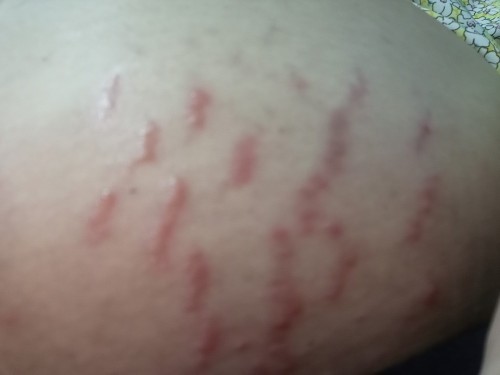 ท้องแม่แตกลายตอนเข้าเดือนที่8ค่ะ คันมากด้วย มีวิธีแก้ยังไงบ้างคะ