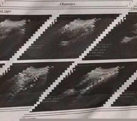 ซาวด์หน้าท้องเพื่อตรวจความปกติ