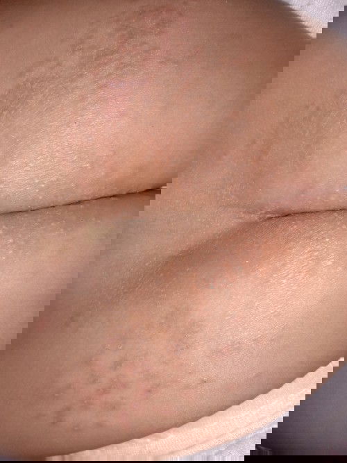 Ruam popok kah ini atau bukan?