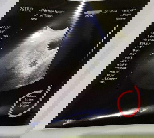 Kantung janin atau bukan ya?